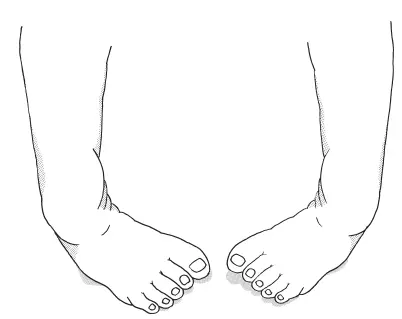 足部の変形